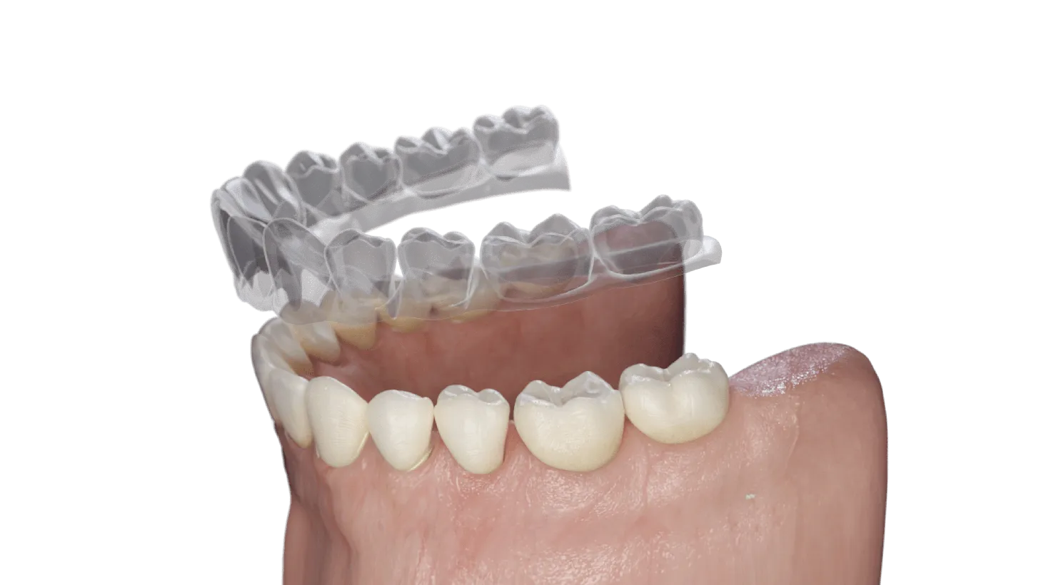 Sabdent, Aligner Schiene