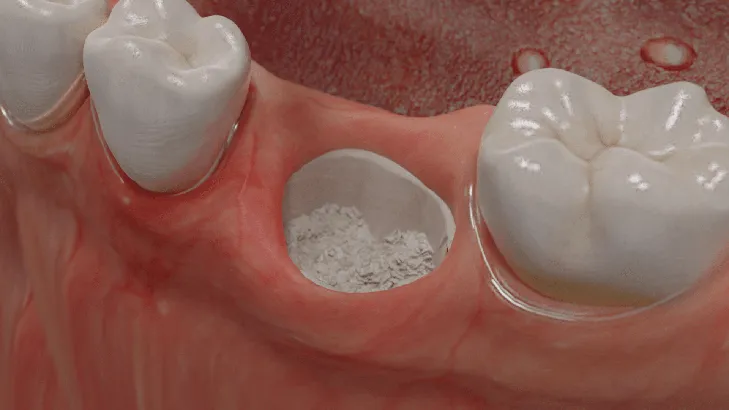 Sabdent, Alveole mit Grinder Material