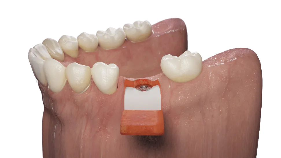 Sabdent, KIV 3. Impl. Insertion