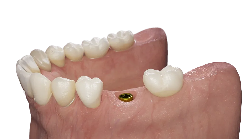 Sabdent, MIMI 2. Insertion Impl.