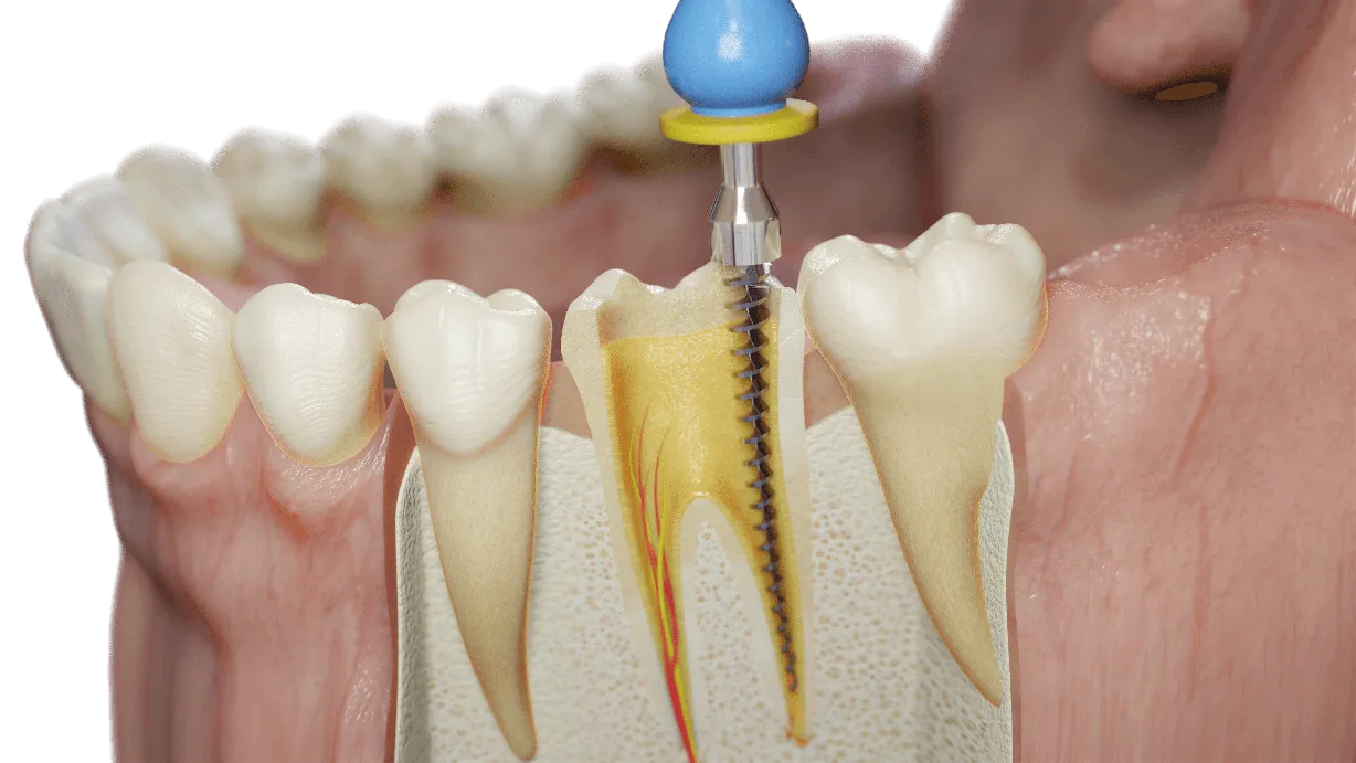 Sabdent, Endodontie